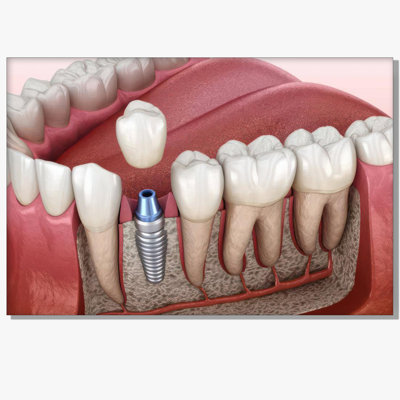 Dental Implant 3D Anatomy Diagram Poster