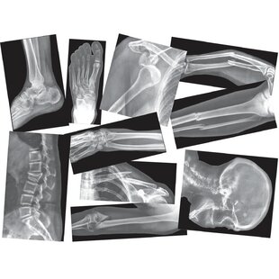 Broken Bones X-rays Educational Tool