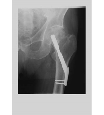 Fixe au fémur, reproduction de photo