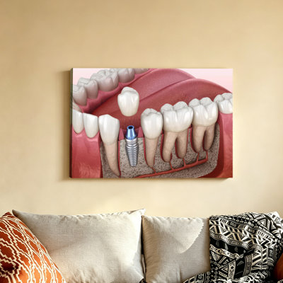 Dental Implant 3D Anatomy Diagram Poster