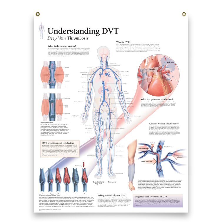 Trinx Understanding DVT Deep Vein Thrombosis Framed Medical Educational ...