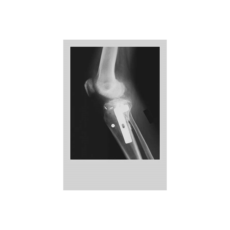 « genoux replacement », impression, H 36 po x l 24 po x P 1,5 po