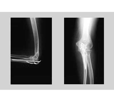 " Shattered Elbow Repair "