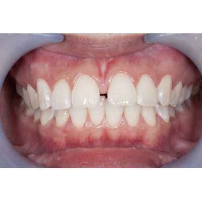 " Diastema "