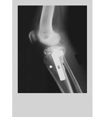 Knee Replacement - Unframed Graphic Art