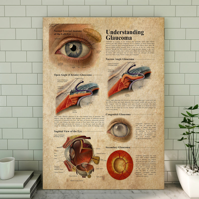 Comprendre la toile tendue «Glaucoma Gallery», décor de connaissance de la santé, décor bleu et brun pour la maison