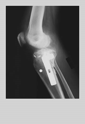 « genoux replacement », impression, H 42 po x l 28 po x P 1,5 po