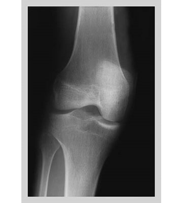" Knee "