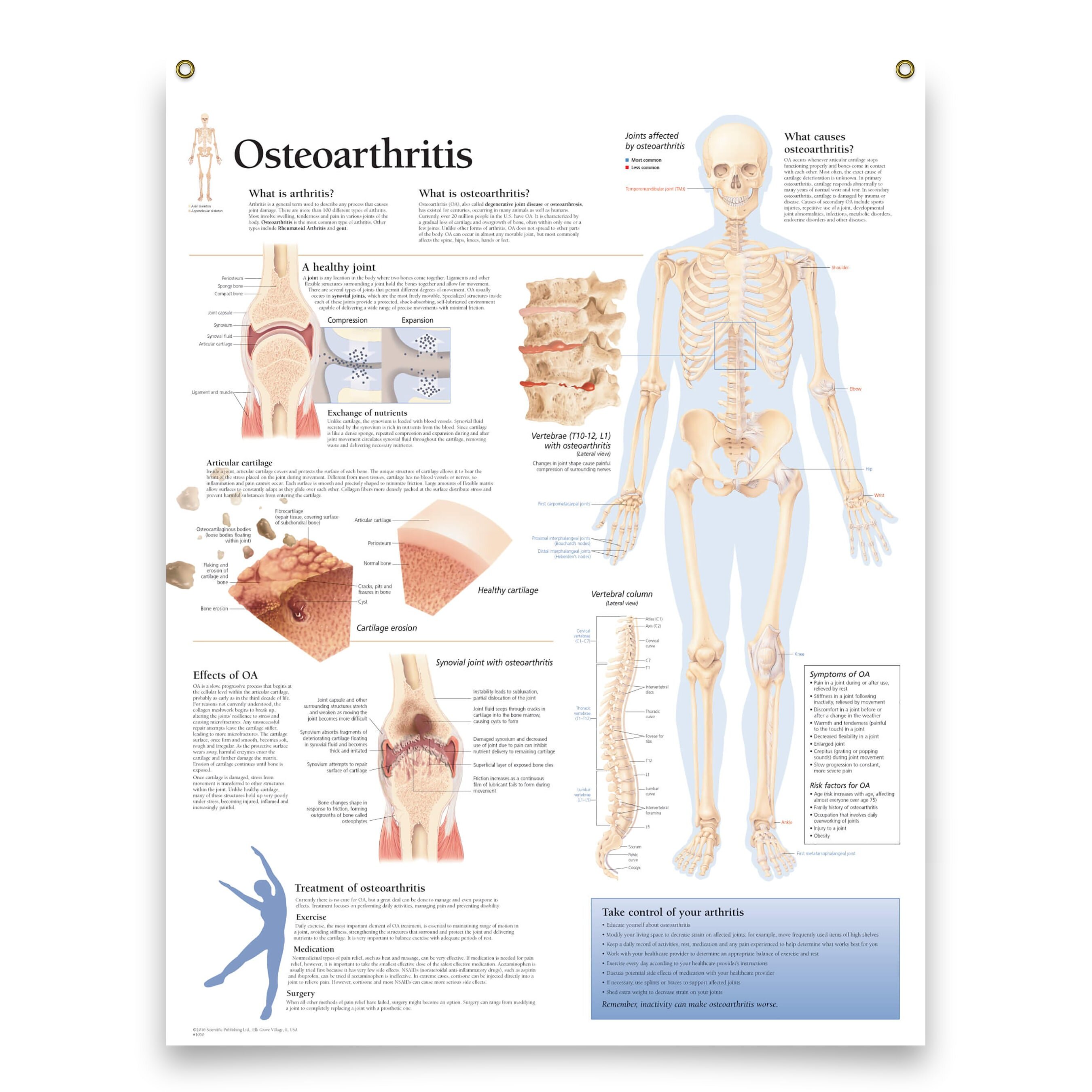 Trinx Set Of 3 Framed Medical Posters: Osteoarthritis Rheumatoid ...