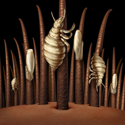 Poux sur cheveux - impression sur toile tendue