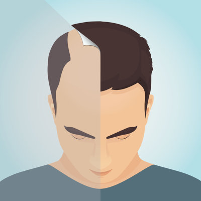Perte de cheveux chez les hommes - Impression sur toile tendue