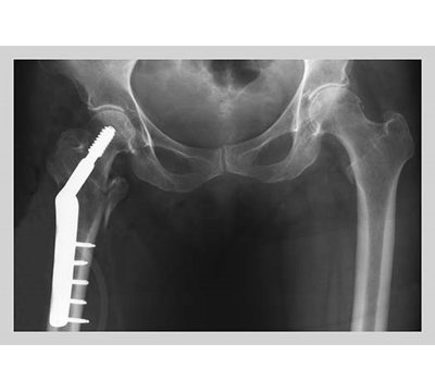 Femur Repair Photographic Print