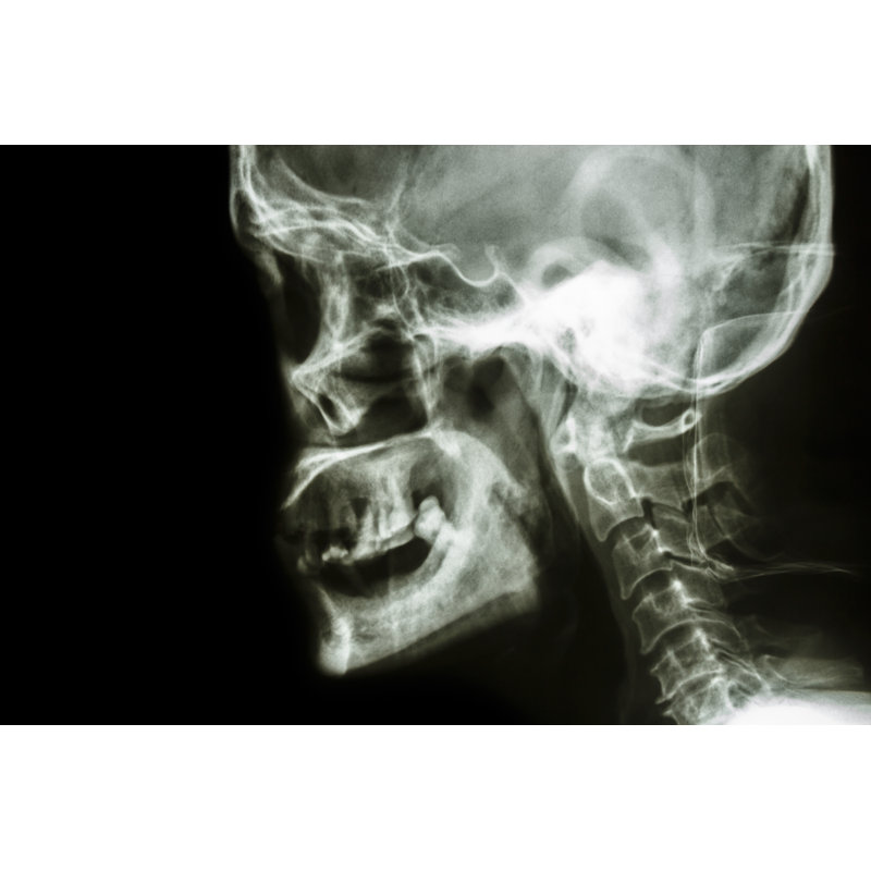 Human's Skull by Stockdevil - Wrapped Canvas Print, 81cm H x 122cm W
